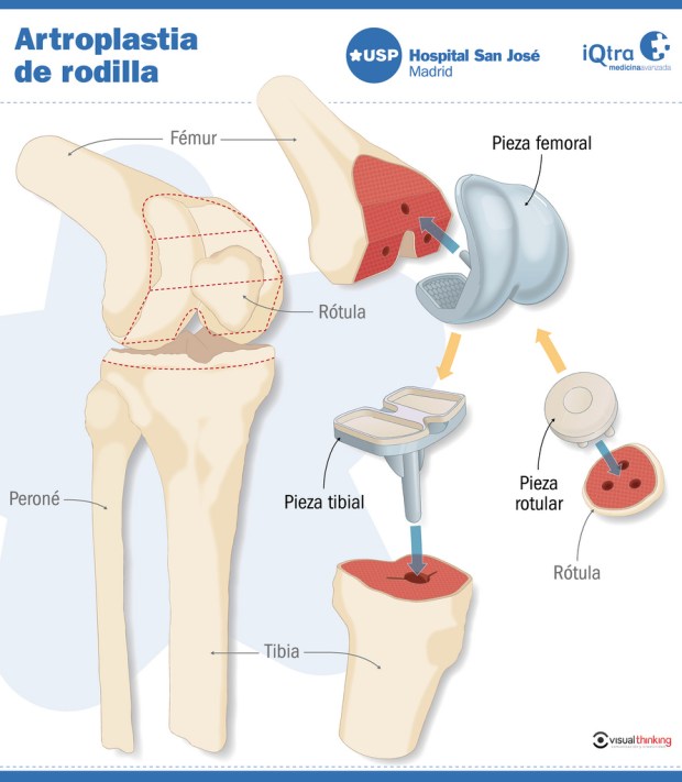 Artroplastia de rodilla