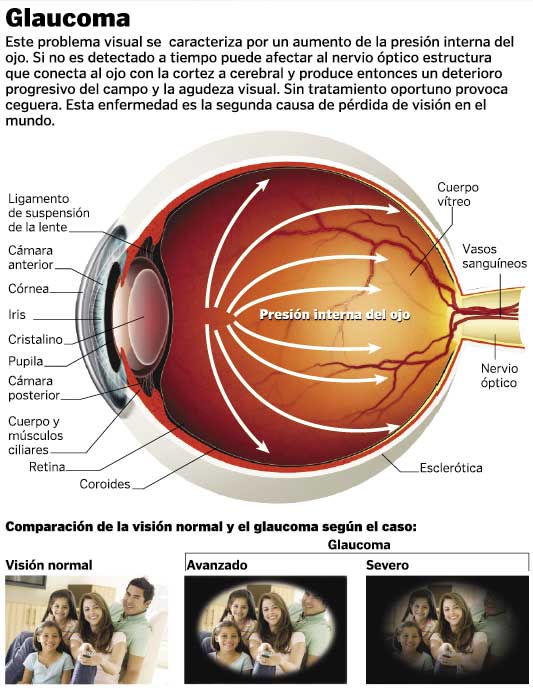 Glaucoma