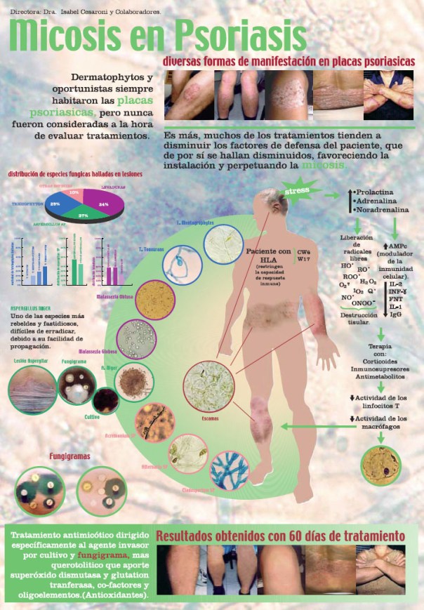 Micosis en psoriasis
