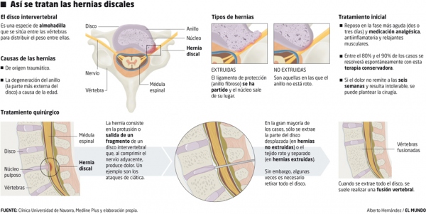 Así se tratan las hernias discales
