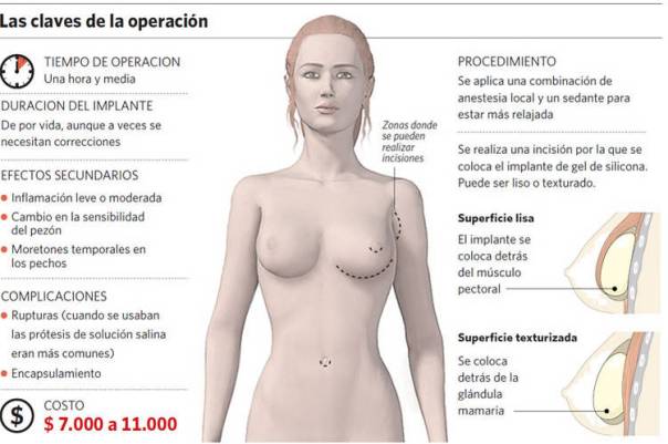 Implantes mamarios