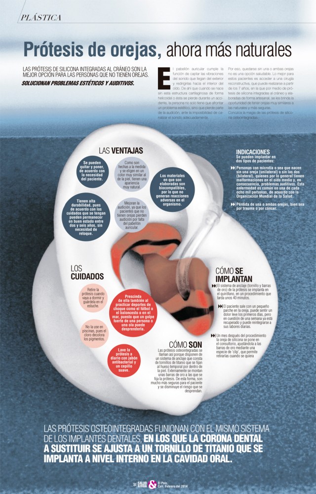 Prótesis de orejas